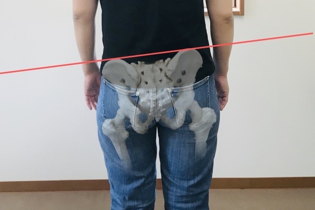 骨盤の歪みを示すイメージ写真。